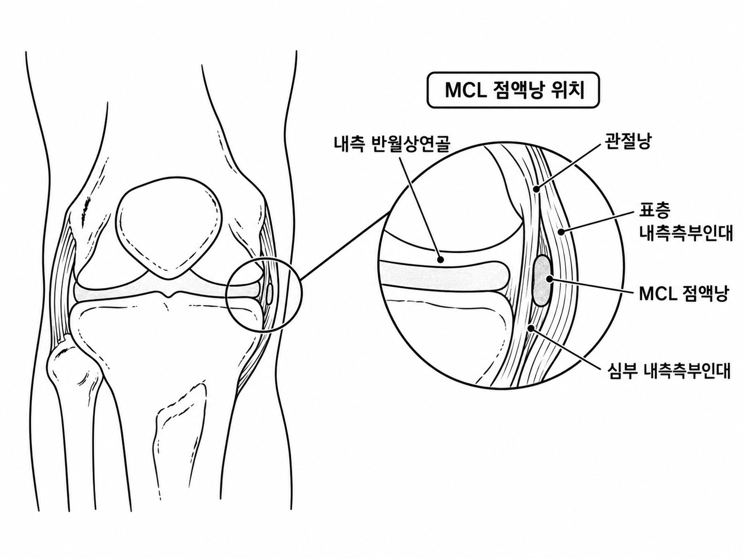 무릎 안쪽 MCL과 MCL bursa 위치 도식